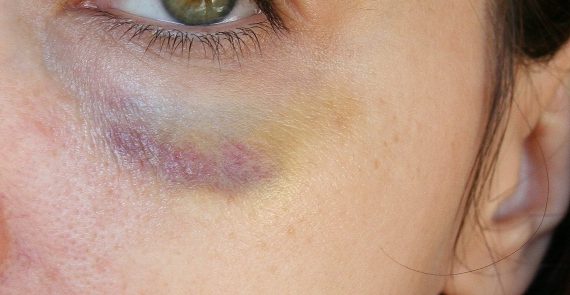 Prevent Bruising