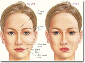 Dermal Fillers