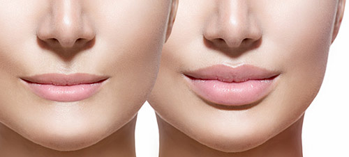 Lip Enhancement