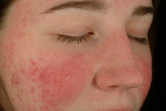 rosacea