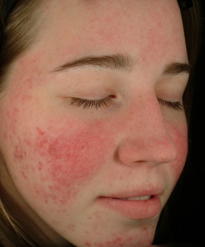 rosacea