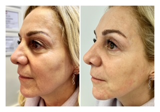 Mid and Lower Face Treatment