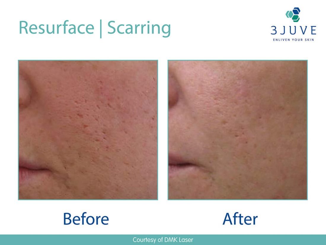 Resurface